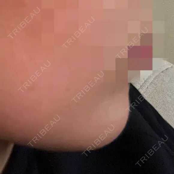 ボトックス（あご） 美容皮膚科エルムクリニック 岡山院 BEFORE メイン用