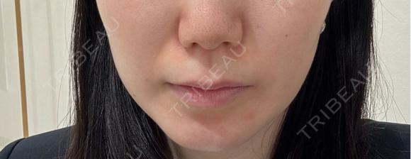 ボトックス（エラ・小顔） / RF（高周波）たるみ治療 PureMe Skin Clinic（ピュアミースキンクリニック麻布） BEFORE メイン用