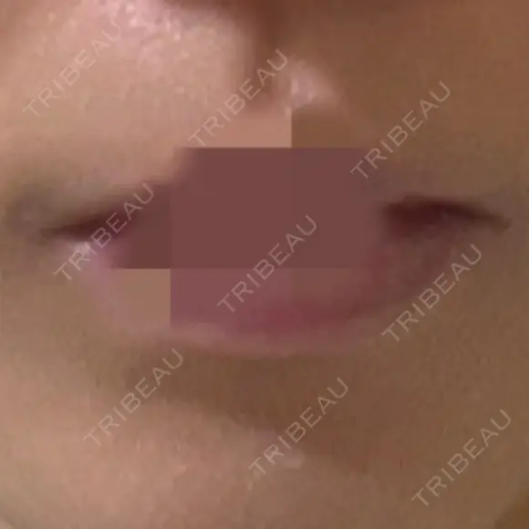 ボトックス（口角） 美容皮膚科エルムクリニック 岡山院 BEFORE メイン用