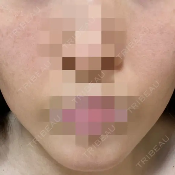 ポテンツァ ルラ美容クリニック 岡山院 BEFORE メイン用