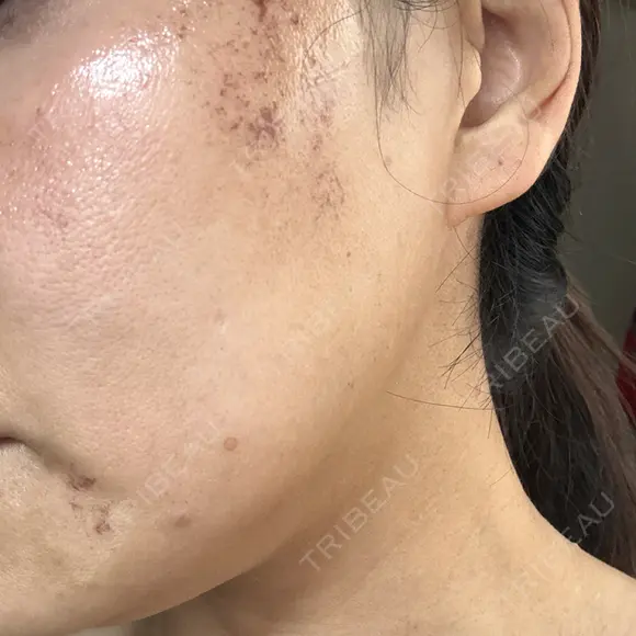 医療脱毛（ワキ） / ルメッカ ルラ美容クリニック 広島院 BEFORE メイン用