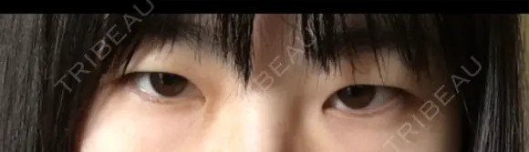 二重切開 / 目頭切開 / 眼瞼下垂（切開） / 目尻切開 ジュエリー美容外科 BEFORE メイン用