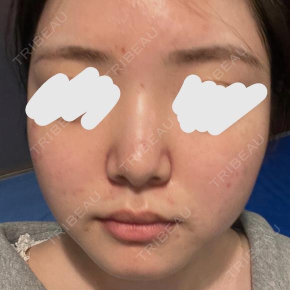 ピーリング（ハリ・ツヤ） / ルメッカ PureMe Skin Clinic（ピュアミースキンクリニック麻布） BEFORE メイン用