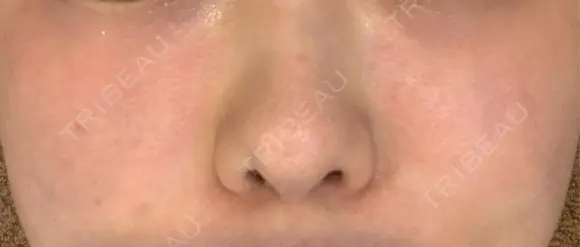 肌育注射（ジュベルックなど） / その他（肌） 新宿Ladies&Gentlemen美容クリニック BEFORE メイン用