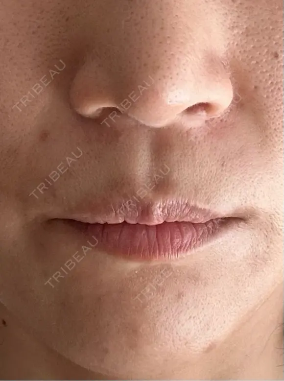 人中短縮 / 小鼻縮小（非切開） 湘南美容クリニック 仙台院 BEFORE メイン用