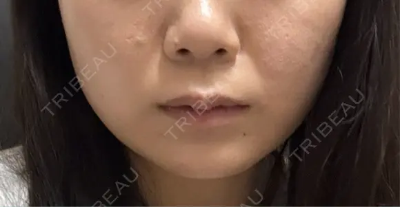 ボトックス（あご） / ボトックス（ガミースマイル） / サーマジェン Wi Clinic （ウィ クリニック）心斎橋院 BEFORE メイン用
