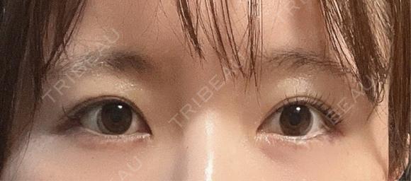 ヒアルロン酸注入（涙袋） Leap beauty clinic BEFORE メイン用
