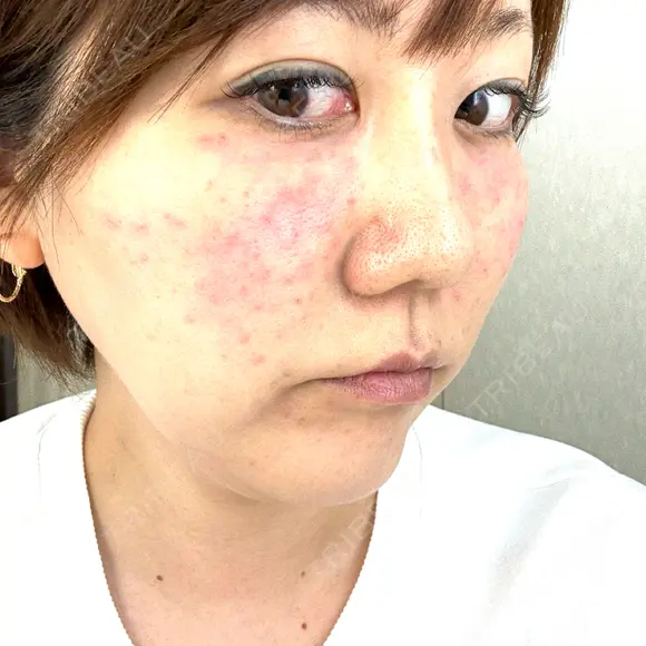 肌育注射（ジュベルックなど） 城本クリニック 岡山院 BEFORE メイン用