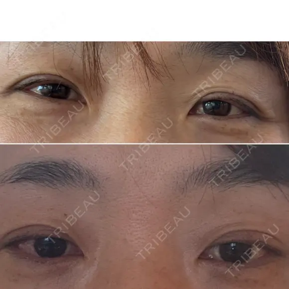 二重切開 / 眼瞼下垂（切開） オーキッド美容クリニック東京御徒町 BEFORE メイン用
