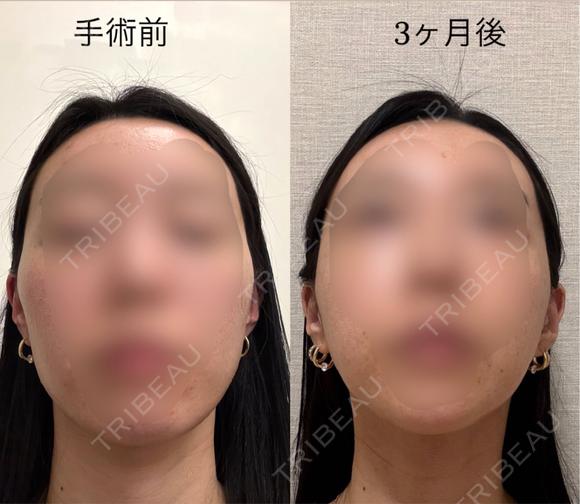 骨切り（あご） / 骨削り（エラ） / 骨削り（頬） セギム美容整形外科 BEFORE メイン用