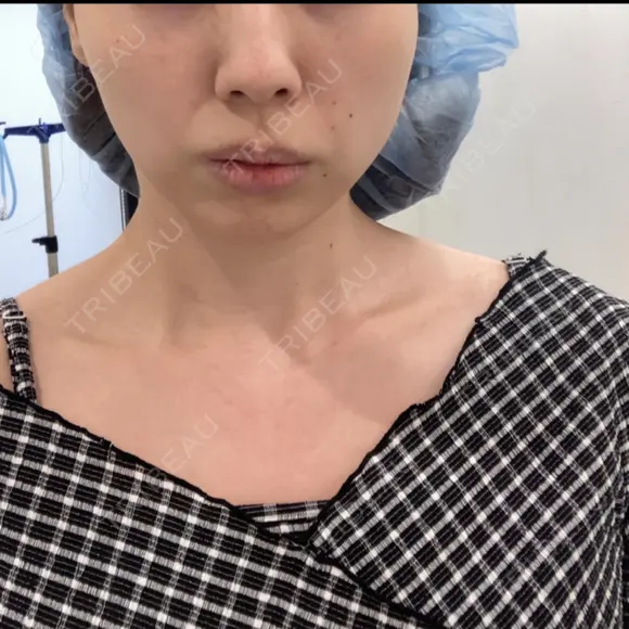 糸リフト Stand by Beauty Clinic BEFORE メイン用