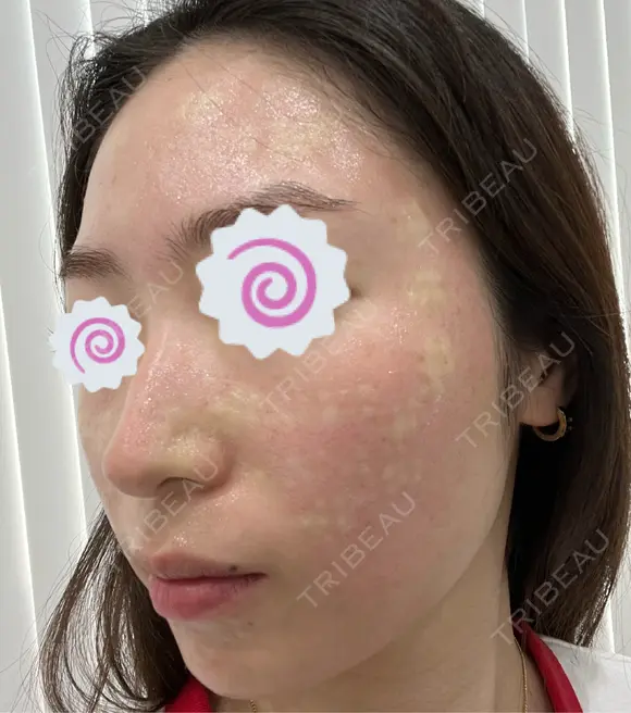 水光注射（ハリ・美肌） スマートスキンクリニック 神保町院 BEFORE メイン用