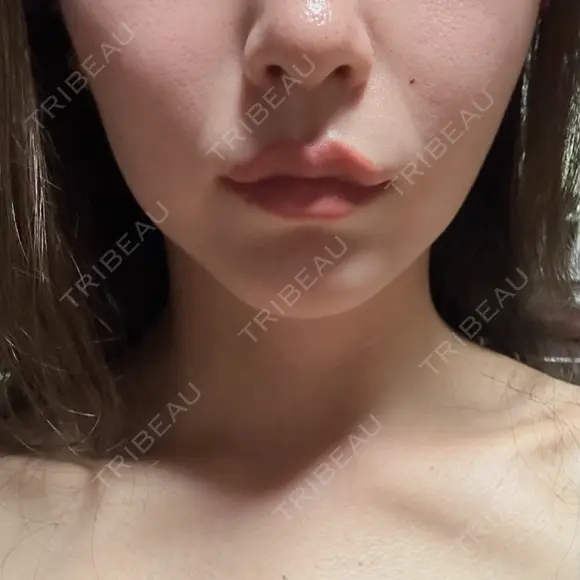 ハイフ（顔） 東京エビスクリニック BEFORE メイン用