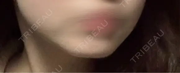 ボトックス（あご） / ヒアルロン酸注入（あご） / ボトックス（エラ・小顔） TCB東京中央美容外科 京都駅前院 BEFORE メイン用