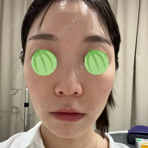 エレクトロポレーション / ピコレーザートーニング（美白・肝斑） 東京美容クリニック 表参道本院 BEFORE メイン用