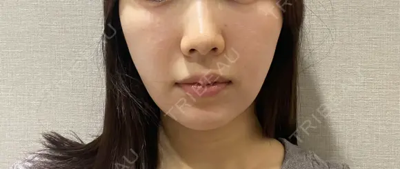 脂肪溶解注射（顔） Nクリニック伏見 BEFORE メイン用