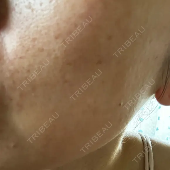 水光注射（ハリ・美肌） しんゆり美容健康クリニック BEFORE メイン用