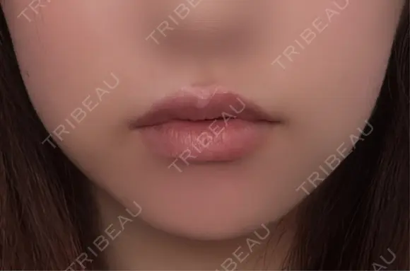 脂肪吸引（顔） ネビュラクリニック 京都院 BEFORE メイン用