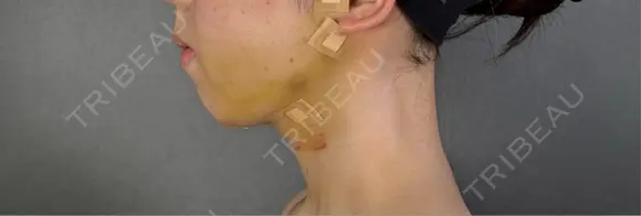 糸リフト / バッカルファット除去 / 脂肪吸引（顔） / ジョールファット除去 / ボトックス（エラ・小顔） アリエル美容クリニック 郡山院 BEFORE メイン用