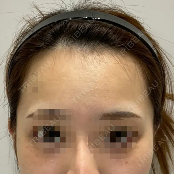 骨切り（あご） / ボトックス（口角） / ヒアルロン酸注入（こめかみ） DMTC CLINIC 渋谷院 BEFORE メイン用