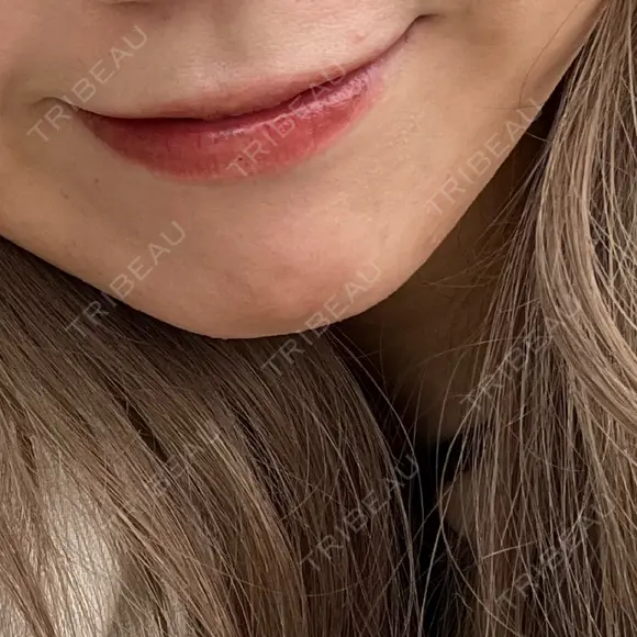 ヒアルロン酸注入（唇） / ボトックス（口角） ルラ美容クリニック 仙台院 / ルラスキンクリニック 仙台院 BEFORE メイン用