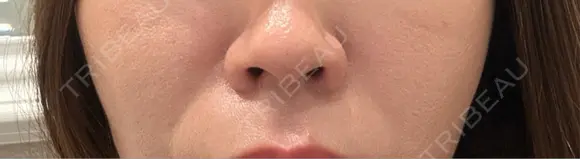 ヒアルロン酸注入（鼻翼基部） 大美会クリニック 梅田院 BEFORE メイン用