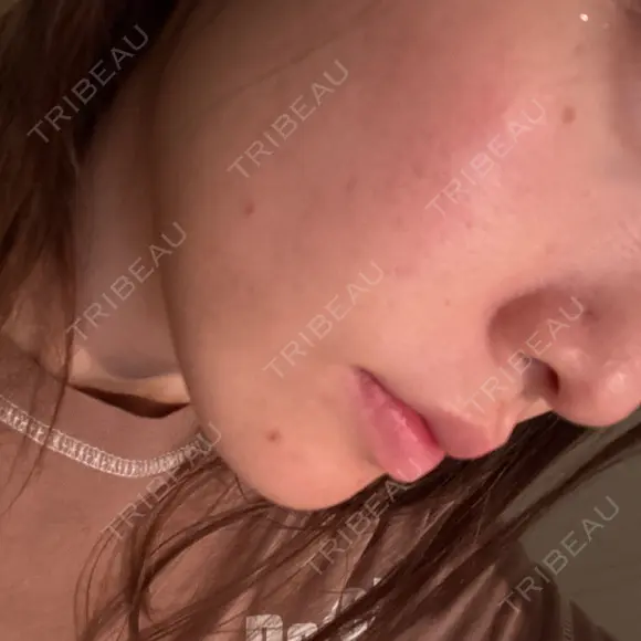 毛穴洗浄（ハイドラフェイシャルなど） MKクリニック 日本橋院 BEFORE メイン用