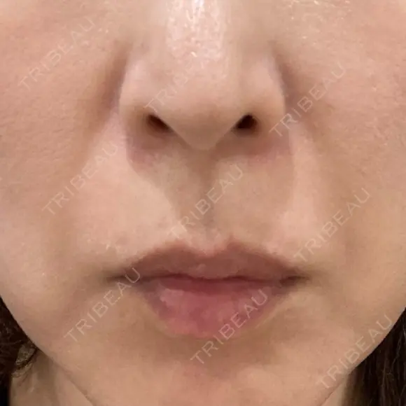 ショッピングリフト BAO CLINIC 梅田院 BEFORE メイン用