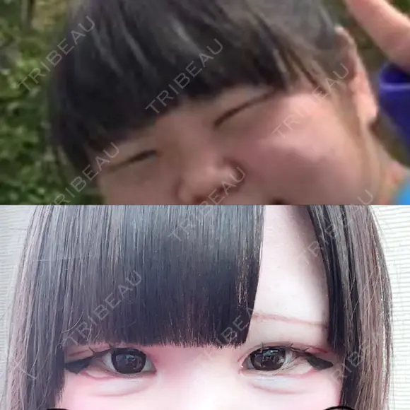 二重埋没 R Beauty CLINIC 銀座院 BEFORE メイン用
