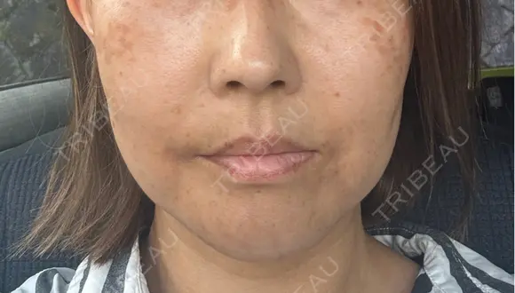 切開リフト / ワキ汗治療（切開） 石倉クリニック 水戸院 BEFORE メイン用