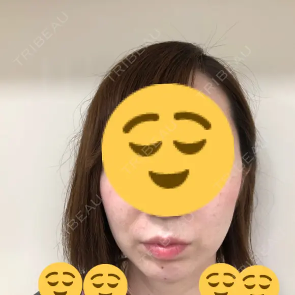 肌ヒアルロン酸注入（たるみ・シワ改善） / ヒアルロン酸注入（あご） ジョウクリニック 松山院 BEFORE メイン用