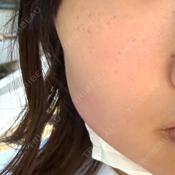 ボトックス（エラ・小顔） ルラ美容クリニック 大阪本院 BEFORE メイン用