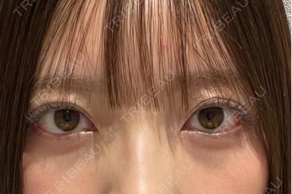 ヒアルロン酸注入（涙袋） eクリニック 横浜みなとみらい院 BEFORE メイン用