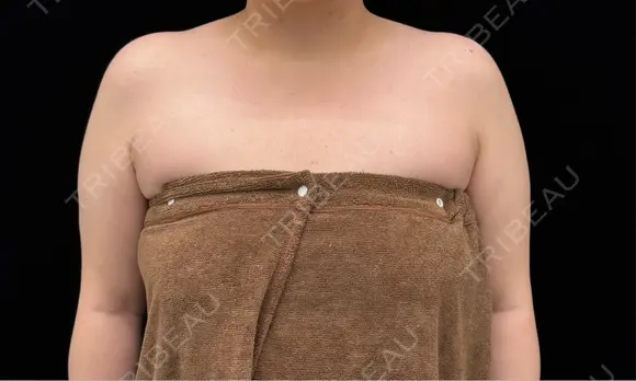 脂肪吸引（二の腕） EMMA CLINIC（エマクリニック） BEFORE メイン用