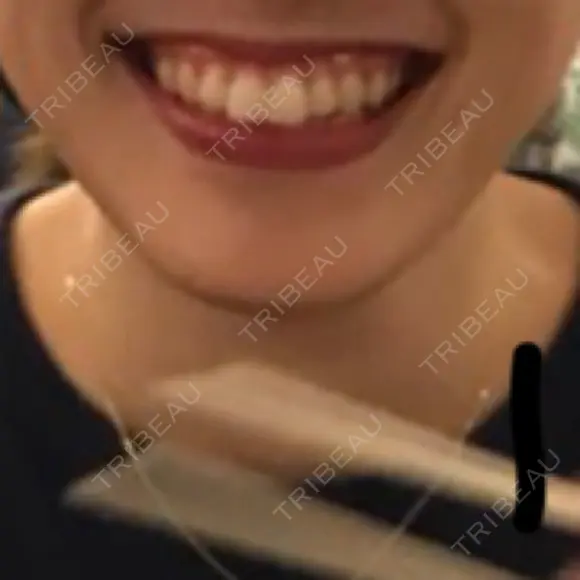 ガミースマイル手術 有楽町美容外科クリニック BEFORE メイン用
