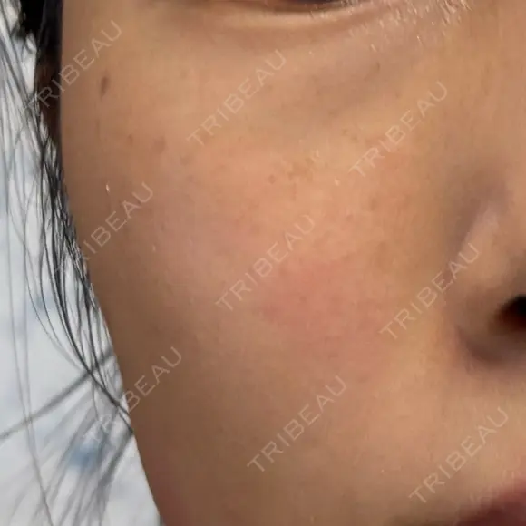 ルメッカ 大美会クリニック 京都烏丸院 BEFORE メイン用