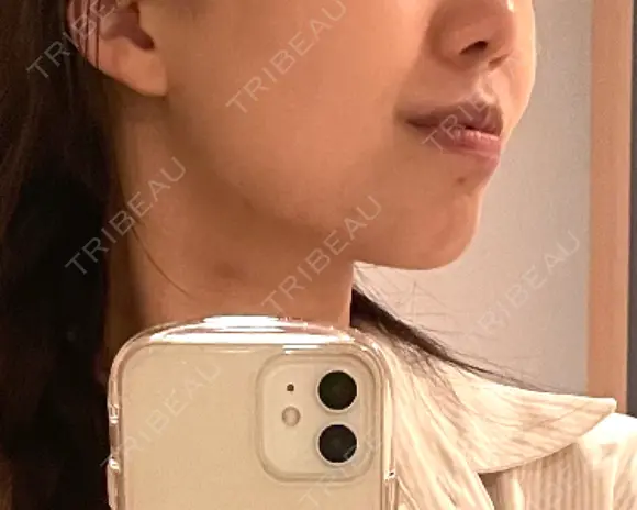 RF（高周波）たるみ治療 Wing clinic 豊中駅前院 BEFORE メイン用