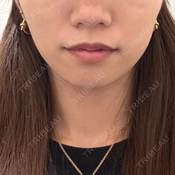 ヒアルロン酸注入（あご） ルラ美容クリニック 渋谷本院 BEFORE メイン用