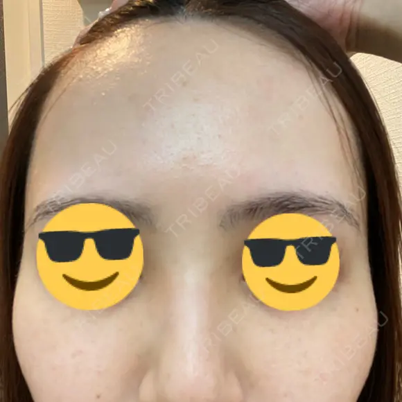 ピーリング（ハリ・ツヤ） FIG CLINIC BEFORE メイン用