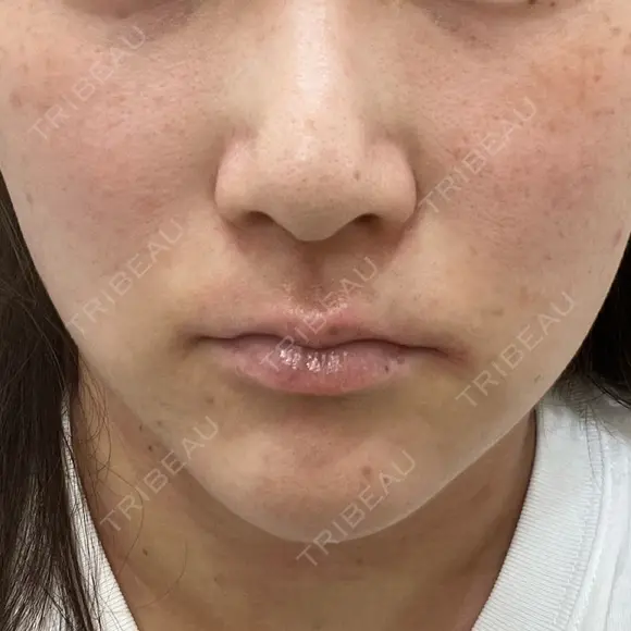 ピーリング（ニキビ・毛穴） 渋谷美容外科クリニック 横浜院 BEFORE メイン用