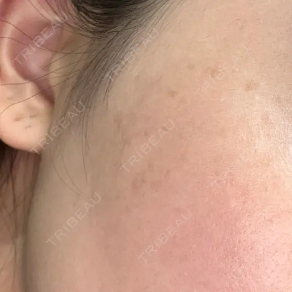 ルメッカ 栄美容クリニック 栄院 BEFORE メイン用