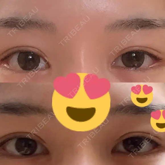 ボトックス（タレ目） フィラークリニック 新宿院 BEFORE メイン用