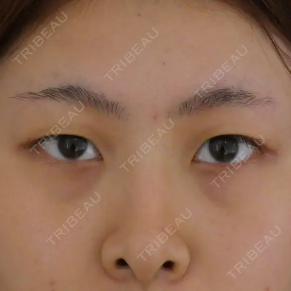 二重埋没 藤・ナチュレ美容クリニック 恵比寿院 BEFORE メイン用