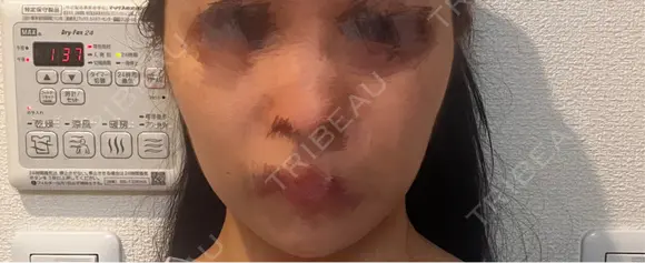 糸リフト / 脂肪吸引（顔） / ボトックス（エラ・小顔） A CLINIC（エークリニック） 新宿院 BEFORE メイン用