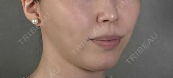 ハイフ（顔） アリエル美容クリニック 郡山院 BEFORE メイン用