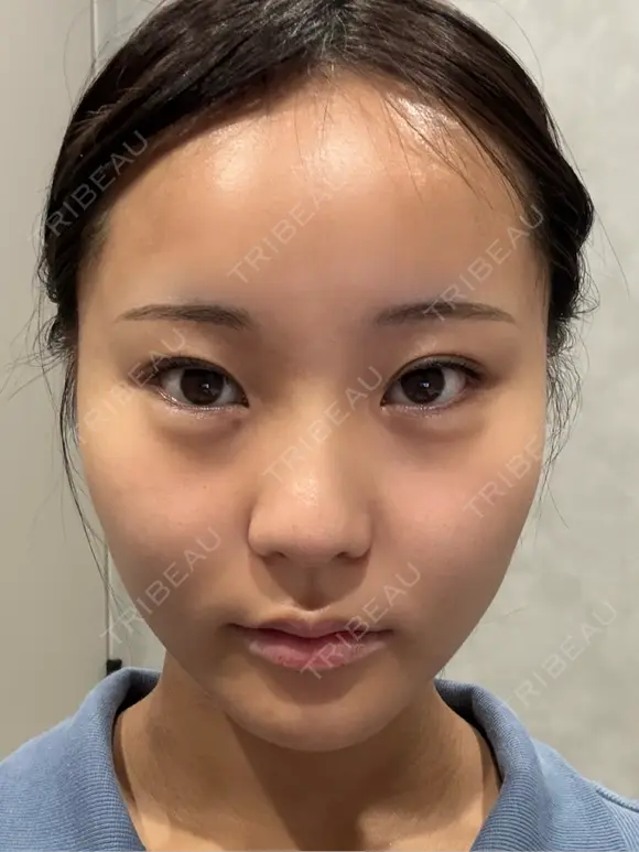 糸リフト / 脂肪吸引注射（顔） 札幌美容外科ネビュラクリニック BEFORE メイン用