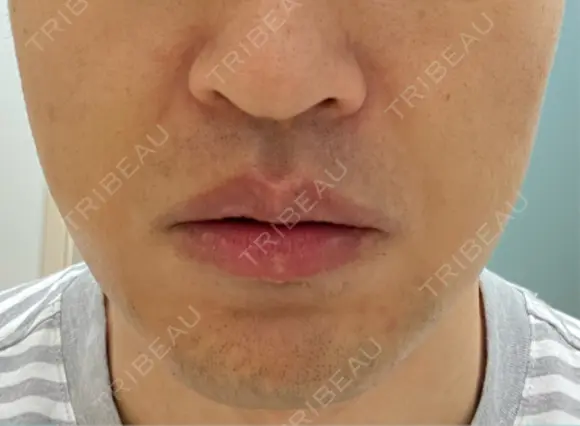 RF（高周波）たるみ治療 湘南美容クリニック 大阪梅田本院 BEFORE メイン用