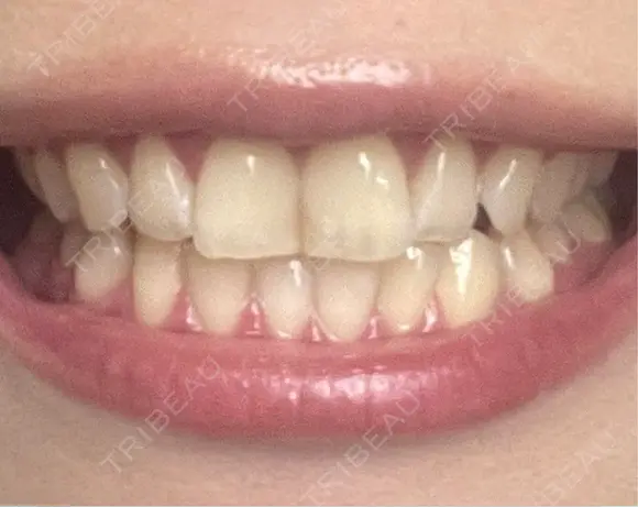 ホワイトニング 銀座本院 歯と美容のクリニック BEFORE メイン用