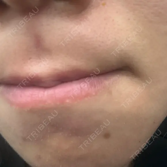 医療脱毛（顔） 新宿Ladies&Gentlemen美容クリニック BEFORE メイン用