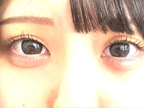 二重埋没 日本ウェルネス再生クリニック BEFORE メイン用